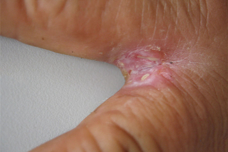 浸渍糜烂型手癣图