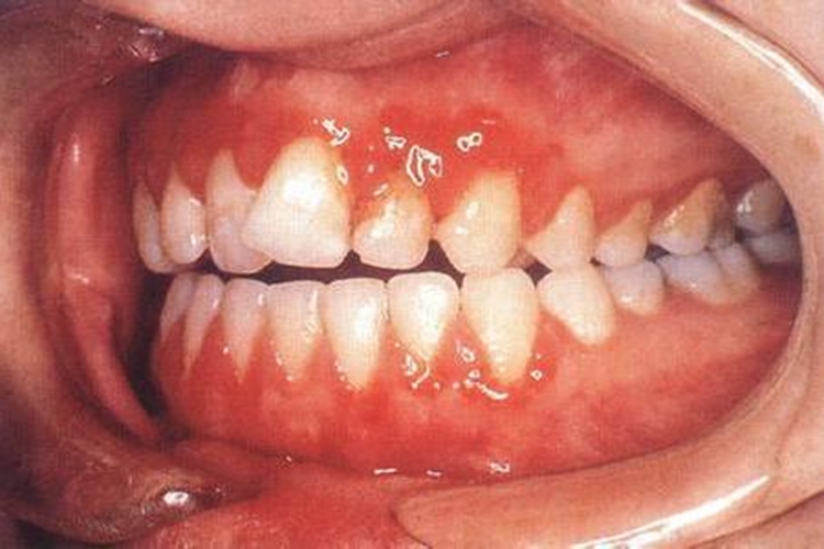 慢性牙龈炎图