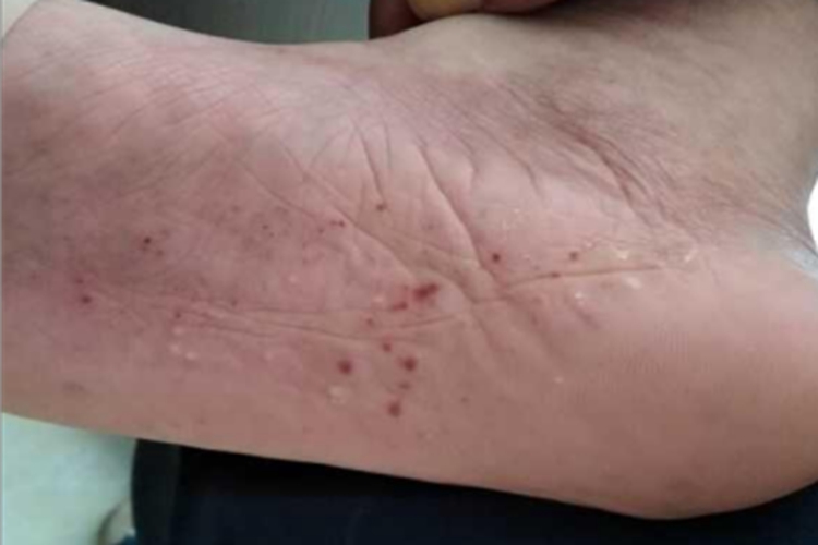 湿疹样型癣菌疹红点图 湿疹样型癣菌疹红点图