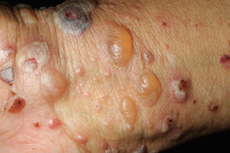 增殖型天疱疮大水疱图