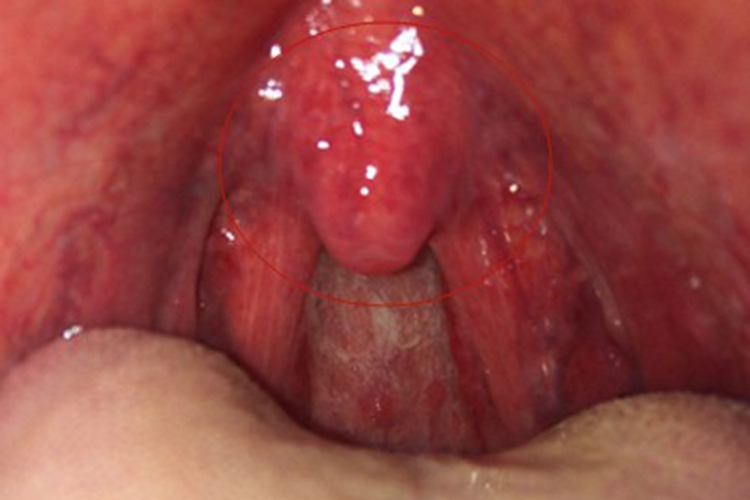 淋菌性咽炎咽喉症状图