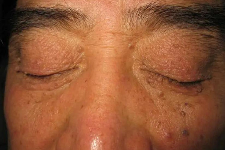 皮肤纤维瘤图 皮肤纤维瘤图