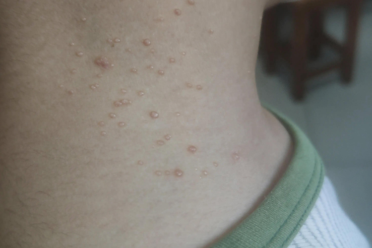 脖子上传染性软疣图 脖子上传染性软疣图