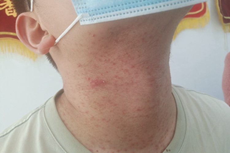 马拉色菌毛囊炎颈部丘疹图 马拉色菌毛囊炎颈部丘疹图