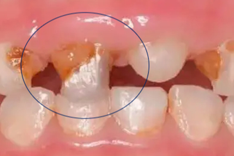 儿童乳牙牙髓坏死图 儿童乳牙牙髓坏死图