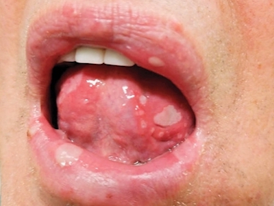下嘴唇和舌头出现大小不一的溃疡,色白,周围发红,常伴有口唇分泌物