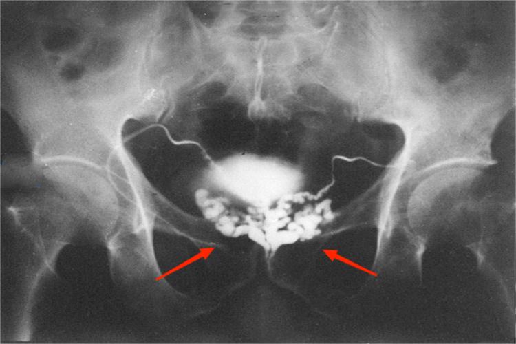 精囊造影CT位置图
