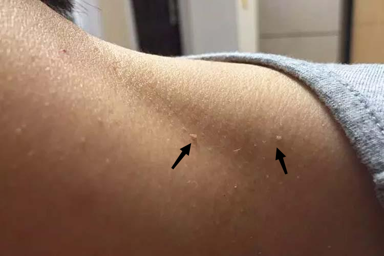 丝状软纤维瘤图