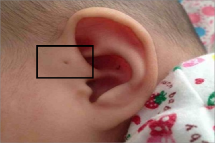 先天性耳前瘘管小坑图