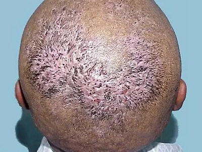 脱发性毛囊炎头皮上大片淡粉色瘢痕图jpg