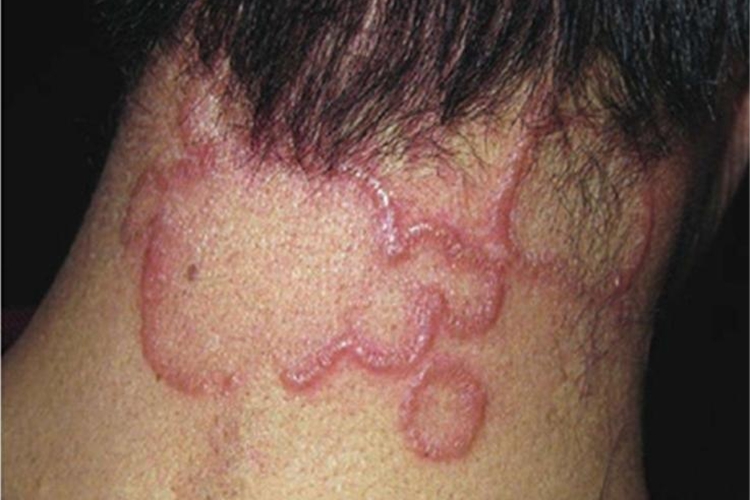 局限型环状肉芽肿后颈斑图 局限型环状肉芽肿后颈斑图