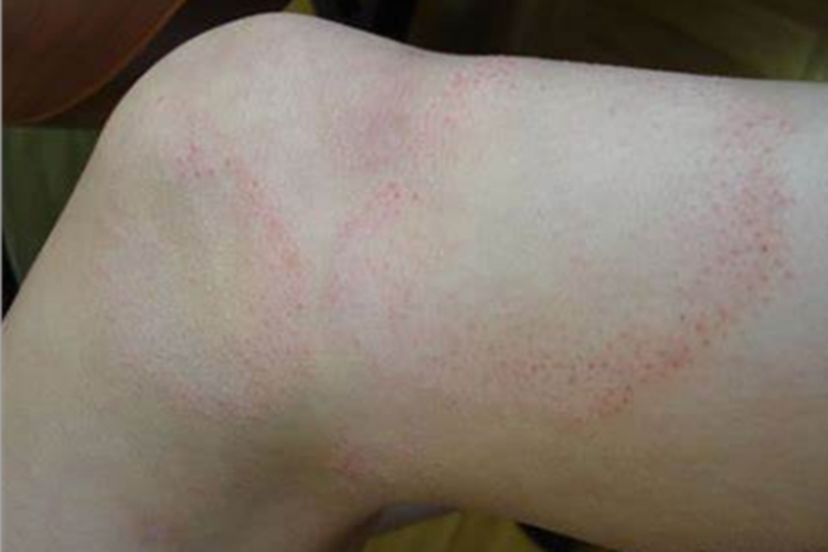 光泽苔藓大腿上有红疹图 光泽苔藓大腿上有红疹图