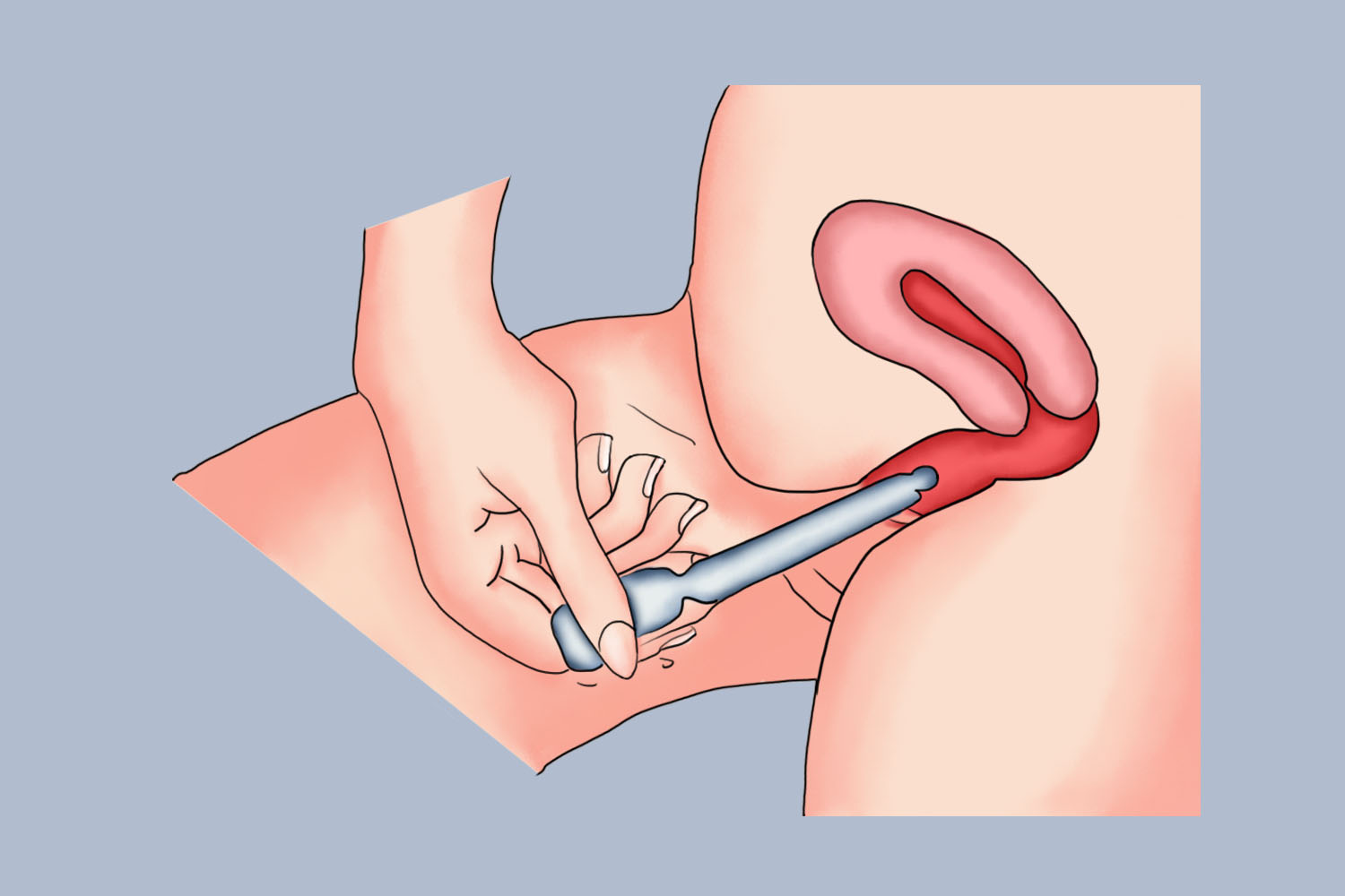 黄体酮凝胶塞到深处图