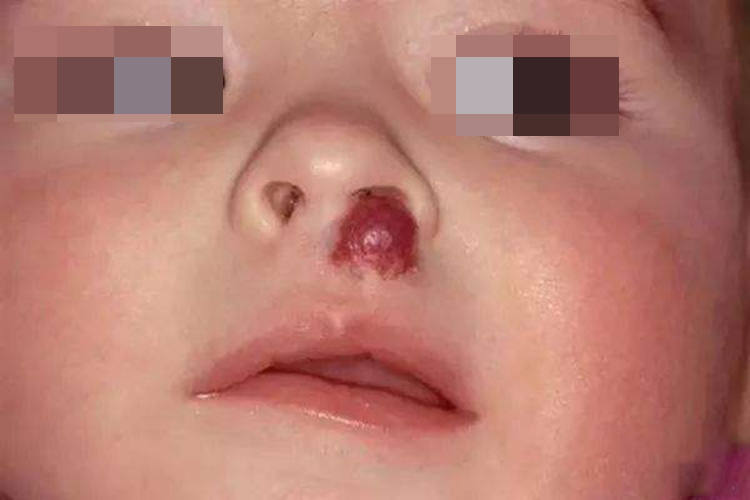婴儿鼻子上红胎记结节图