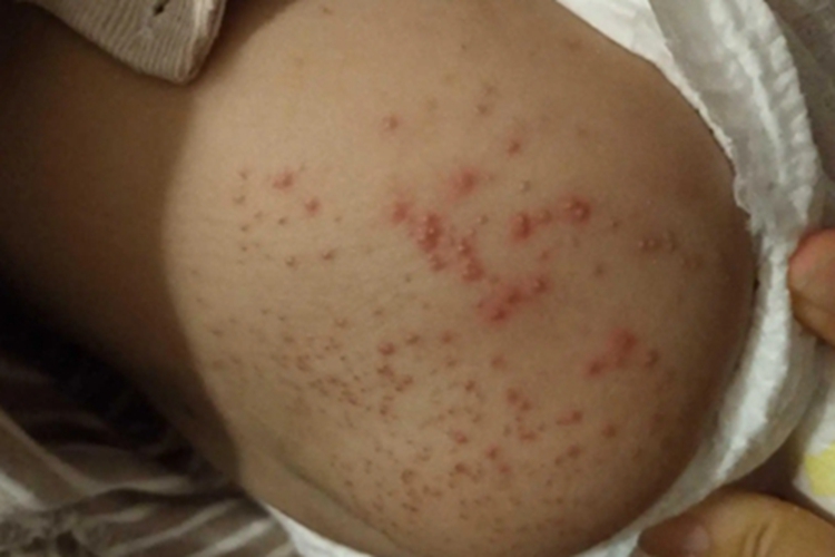 淋巴瘤样丘疹病臀部丘疹图 淋巴瘤样丘疹病臀部丘疹图