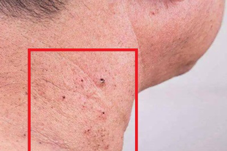 皮肤基底细胞癌侧颈症状图