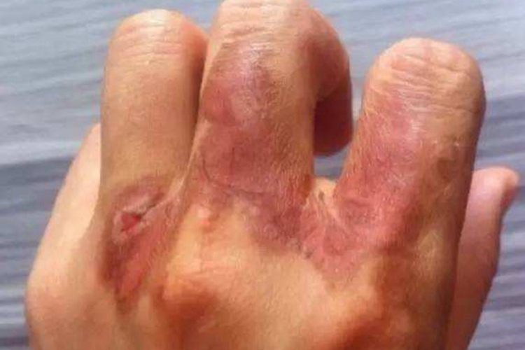 Ⅲ度烫伤痊愈图