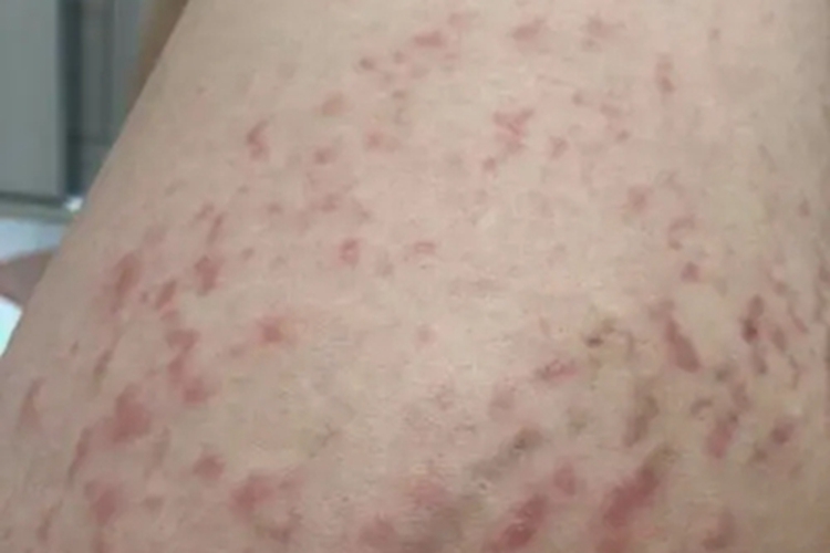 妊娠多形疹症状图 妊娠多形疹症状图