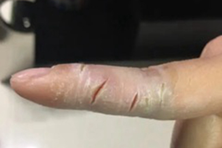 职业性角化过度、皲裂手指症状图