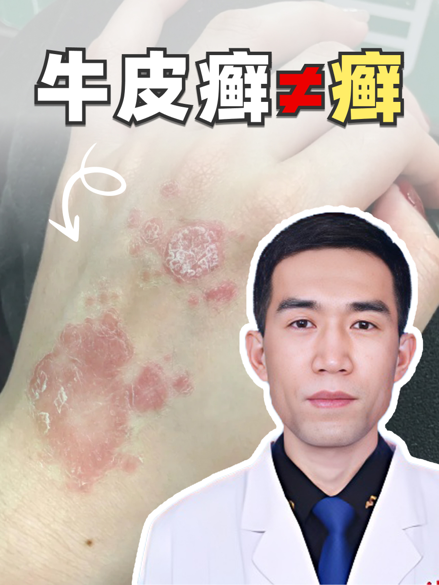皮肤科医生辟谣！牛皮癣根本不是 “癣”！