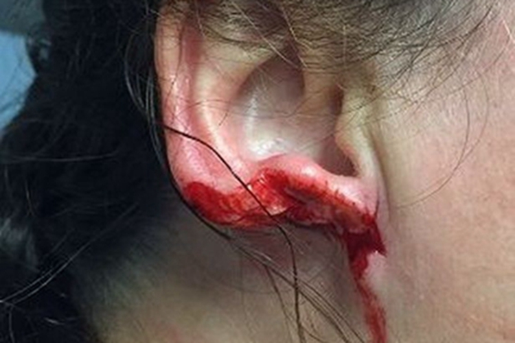 耳廓外伤耳廓出血图