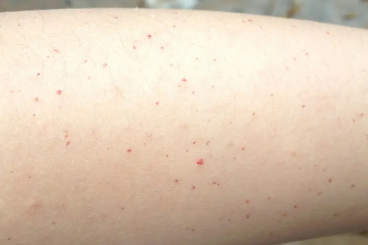 腿上针尖大小出血点紫癜图