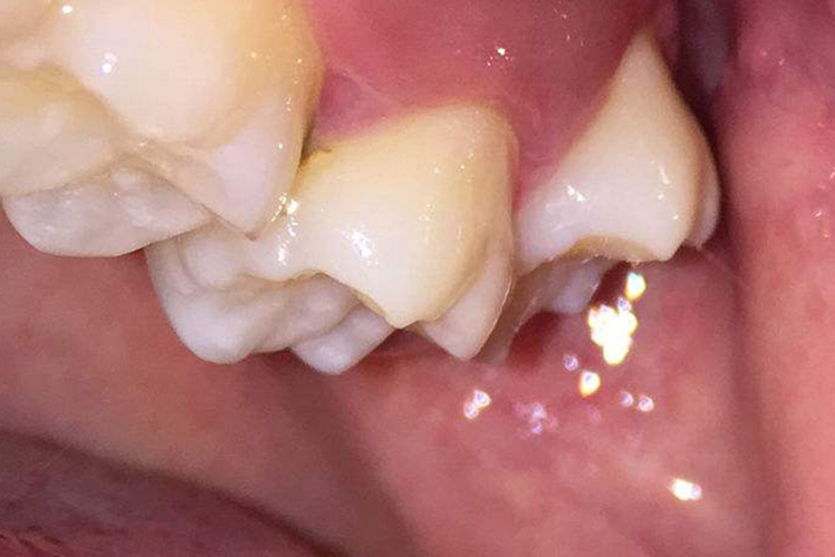 牙周炎导致后槽牙往外歪图 牙周炎导致后槽牙往外歪图