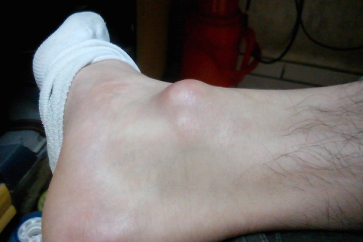 踝关节骨质增生图 踝关节骨质增生图