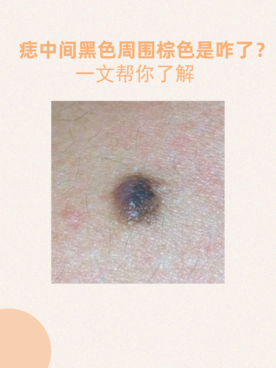 痣中间黑色周围棕色是咋了？一文帮你了解