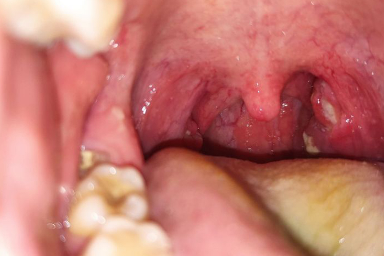 扁桃体化脓减轻图