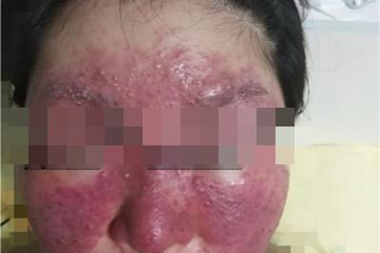 红斑毛细血管扩张型玫瑰痤疮斑图