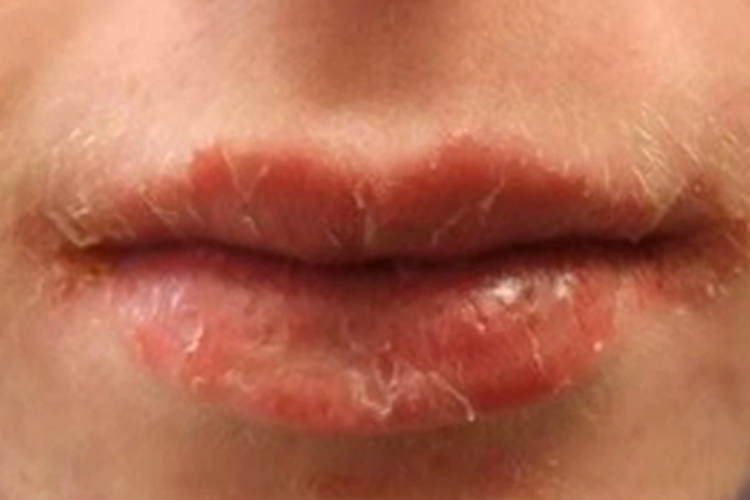 维生素A过多症嘴唇脱皮图