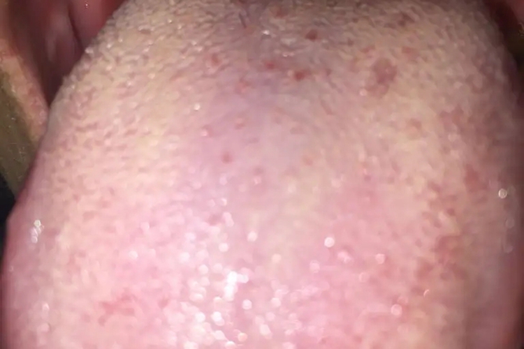 小孩舌头根部舌乳头图