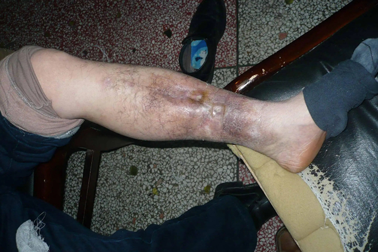 慢性骨髓炎初期图