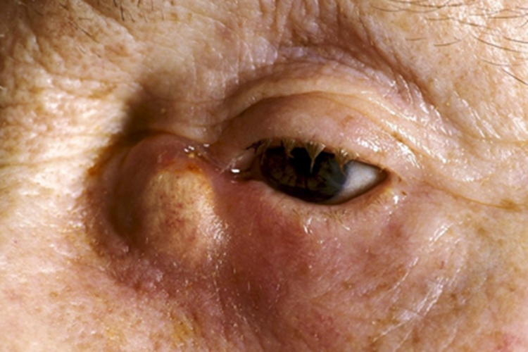 眼眶海绵状血管瘤症状图 眼眶海绵状血管瘤症状图