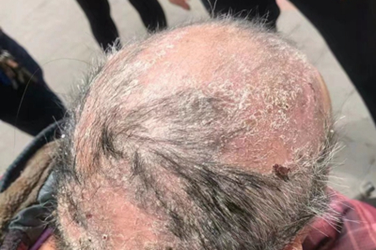 慢性湿疹头皮症状图