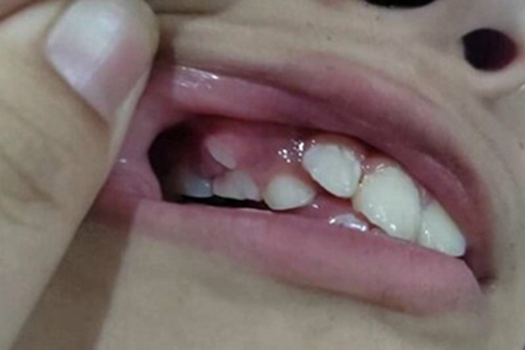 龅牙牙齿外边长了一颗牙图 龅牙牙齿外边长了一颗牙图