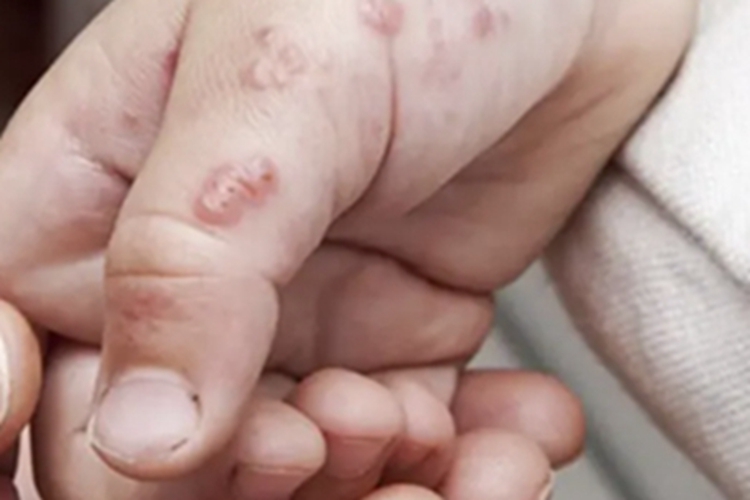 汗疱疹手指起大水疱图