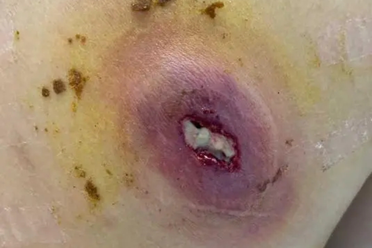 脓根拔出图 脓根拔出图