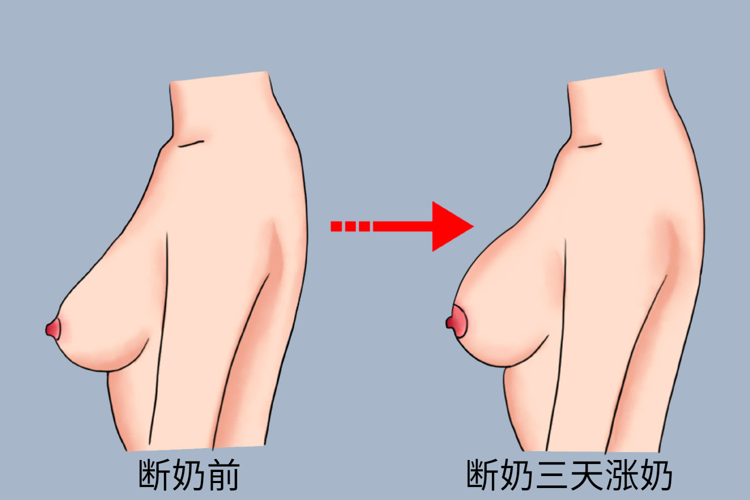 乳房涨奶肿胀图