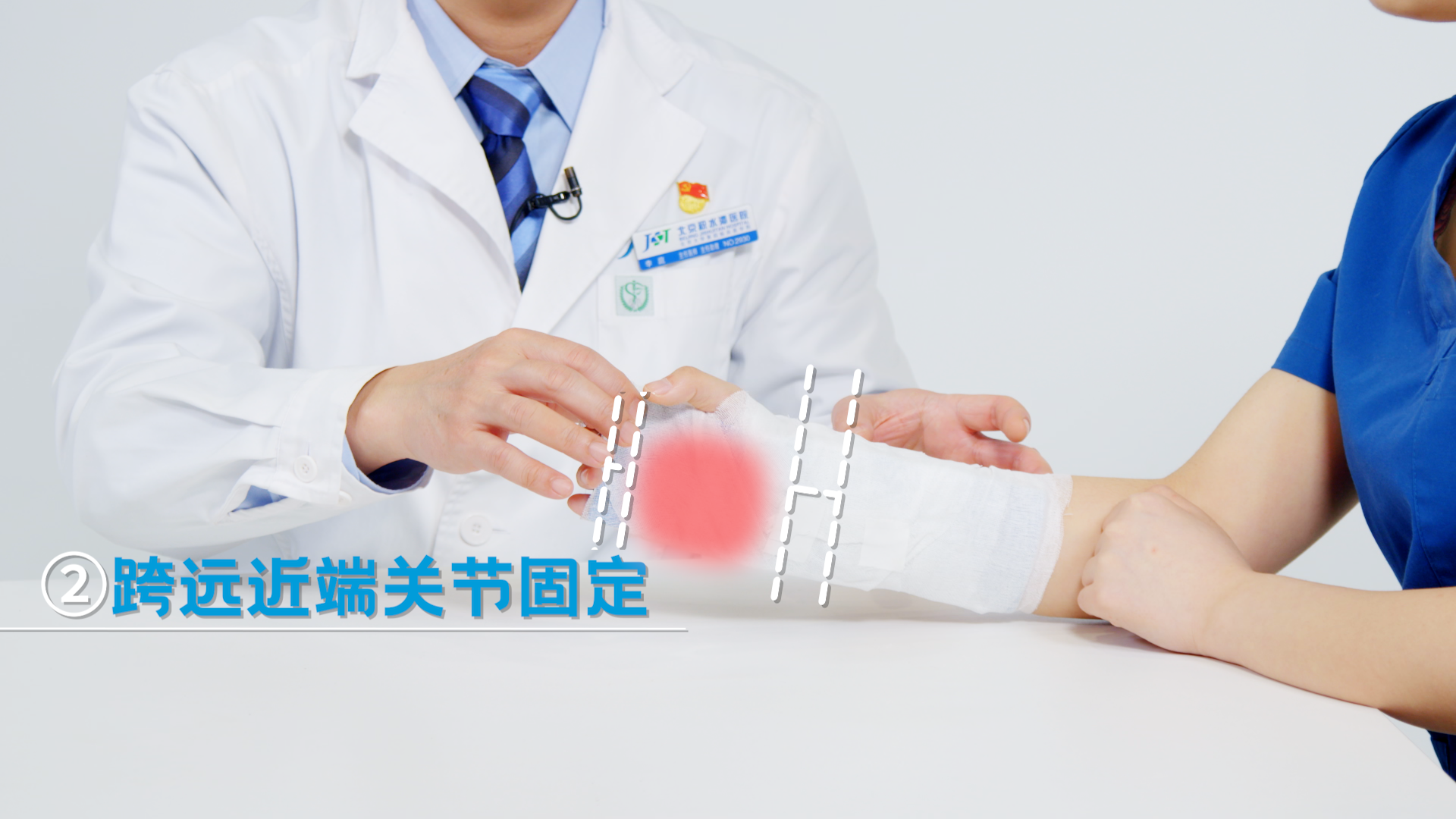 2跨远近端关节固定.png