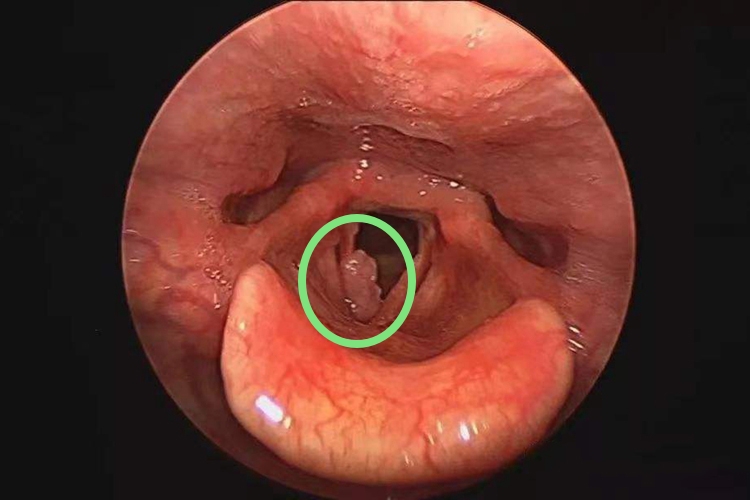 喉癌内窥镜下图