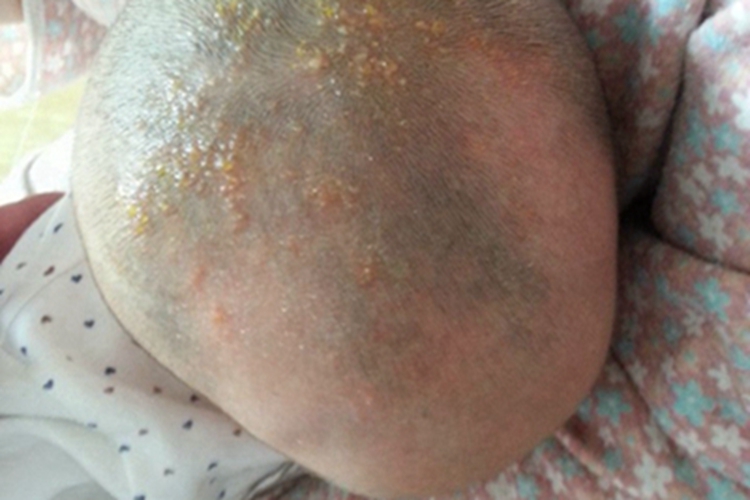 自体敏感性湿疹小疱图