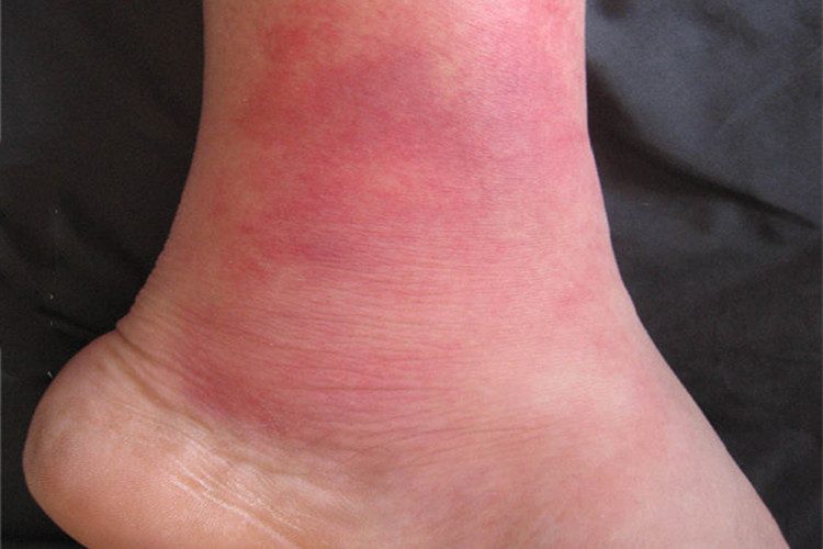 丹毒脚踝症状图 丹毒脚踝症状图