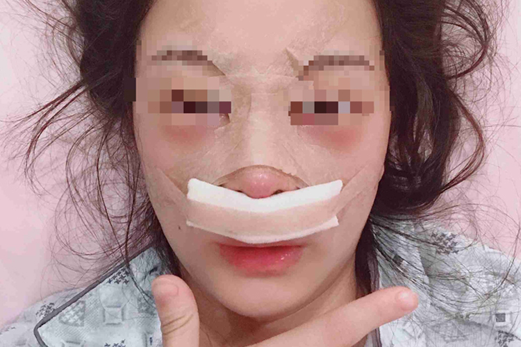 隆鼻术肿样图 隆鼻术肿样图