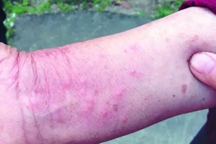 蚁蜇伤手腕起疙瘩图