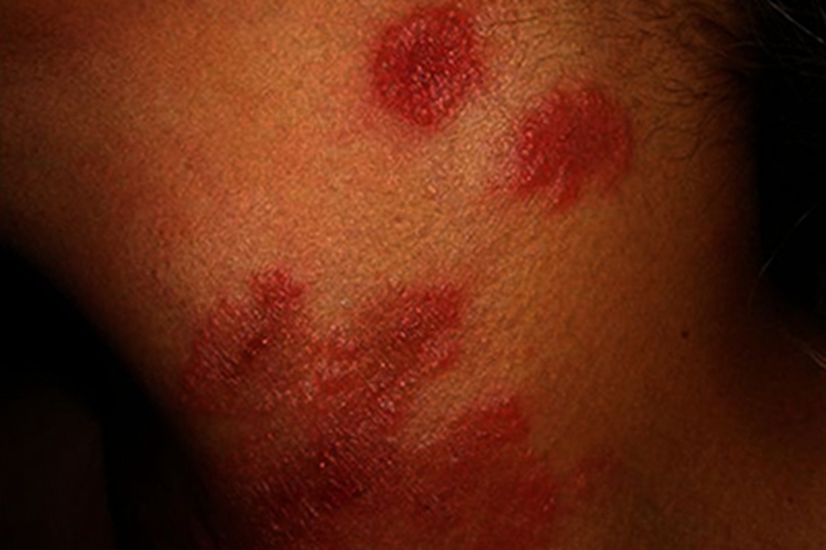 嗜皮菌病颈部红斑图