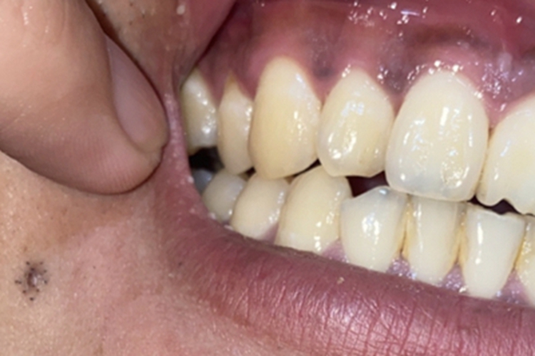 牙龈萎缩牙龈缘回缩不圆滑图