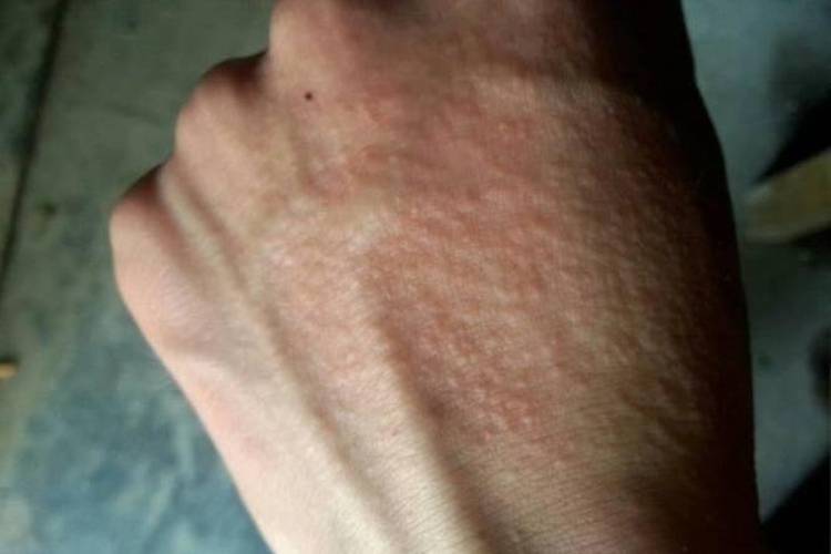 手过敏局部丘疹图