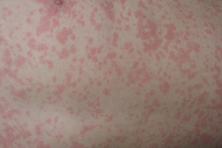 小儿麻疹红色斑丘疹图